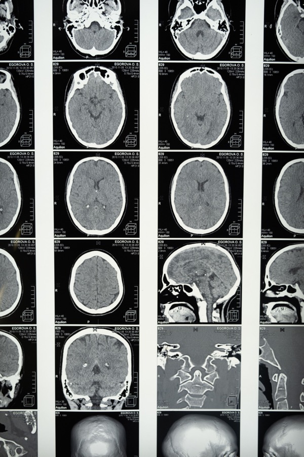 Brain CT scan images