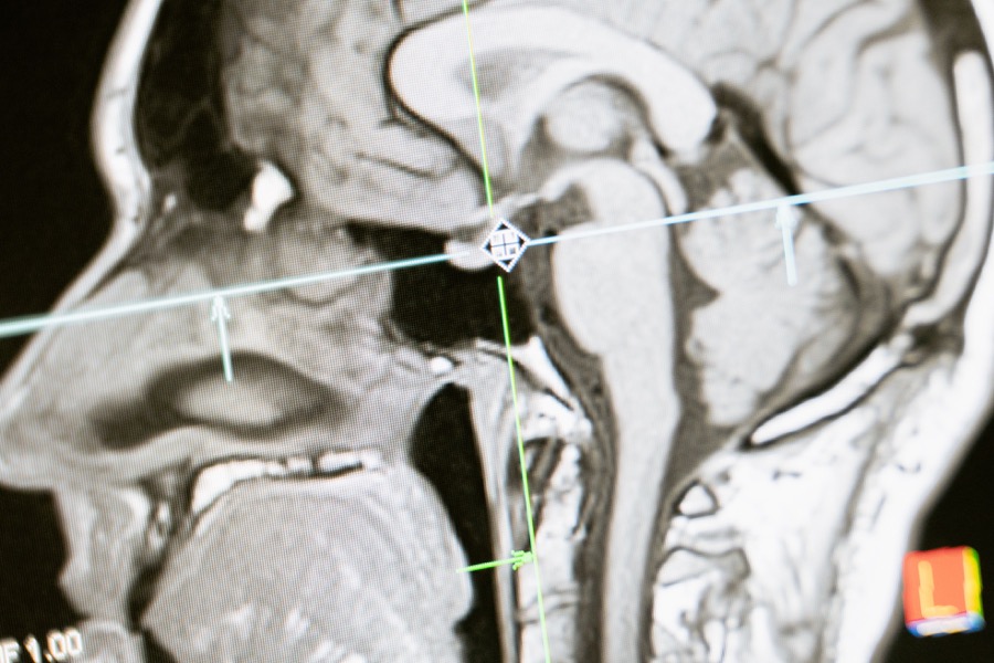 MRI brain scan close-up